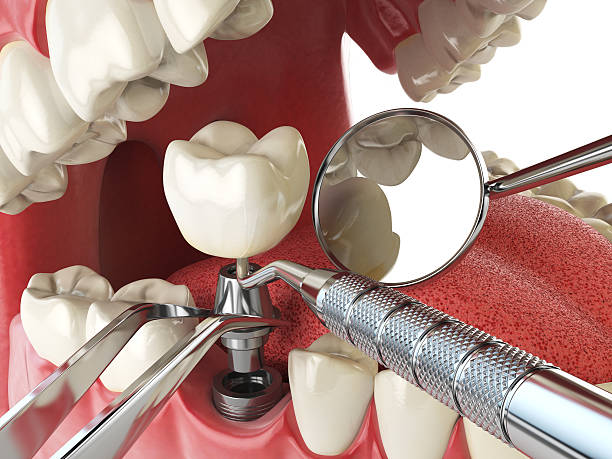 Best Emergency Root Canal Treatment in Flat Rock, NC